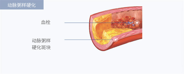 动脉粥样硬化